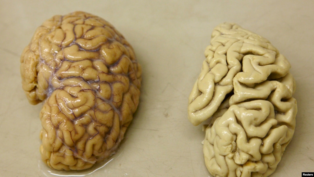 FILE - One hemisphere of a healthy brain (L) is pictured next to one hemisphere of a brain of a person suffering from Alzheimer disease.