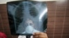 Simple Blood Test Diagnoses People With Active TB